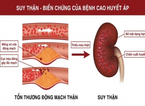Cảnh Báo Ảnh Hưởng Của Bệnh Tăng Huyết Áp Đến Thận